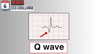 Day 6 Pathological Q waves on ECG  30Day ECG challenge [upl. by Guibert67]