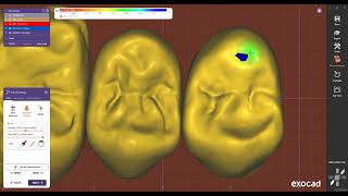 2 anatomic bridge dental software [upl. by Eilema150]