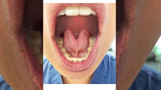 Tongue Tie Severity Grades 14 Tongue Range of Motion Ratio [upl. by Lapides]