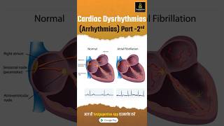 Cardiac Dysrhythmias Arrhythmia Part2  Types of Cardiac Arrhythmia Cardiac Dysrhythmias [upl. by Gadmann]