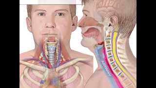 Complications of ACDF  Hematoma Formation  Airway Obstruction  Colorado Spine Surgeon [upl. by Oap743]