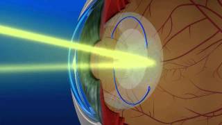 YAG laser used after cataract surgery [upl. by Bower952]