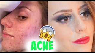 Como eu me livrei das ESPINHAS ACNE [upl. by Neroled191]