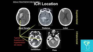 Intracerebral Hemorrhage Part 2  Health4TheWorld Academy [upl. by Leasim]