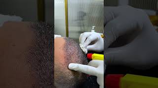 First Shampoo Headwash after Hair Transplant  Cara Clinic [upl. by Avehsile]