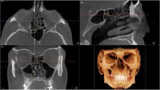 CBCT Interpretation Paranasal Sinuses Movie Sneak Peak [upl. by Uund]