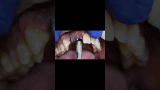 Mandibular molars single pieces impalnt tapping test post 1year shorts [upl. by Terrej]