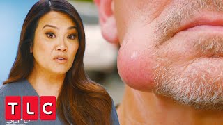 Squeezing Out a Swollen Jaw Lump  Dr Pimple Popper A Pimple Carol [upl. by Fredela]