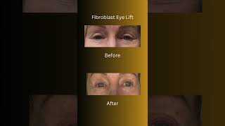 Fibroblast  Eye Lift  fibroblast plasmapen orangecounty [upl. by Given]