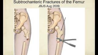 Proximal femur fractures how to identify and avoid malreduction malrotation [upl. by Warder]