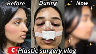 i got a rhinoplasty in TURKEY amp documented my entire recovery nose job vlog [upl. by Roselba401]