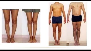 How To Straighten Bow Legs How To Correct Knock Knees Knock Knees Surgery Fix Bow Legs [upl. by Oryaj]