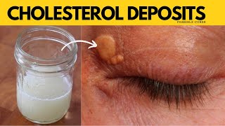 Fastest Way To Get Rid Of Xanthelasma  Squeeze Out Cholesterol Deposits Around Your Eyes [upl. by Kcirttap963]