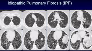 CHEST 2016 video sessions HRCT of the chest [upl. by Akinahc]