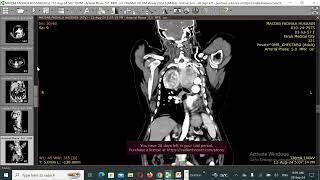 Carcinoid tumor of the lung [upl. by Donnie]