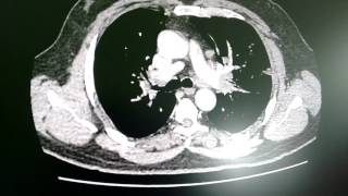 Lung sarcoidosis [upl. by Wyndham]