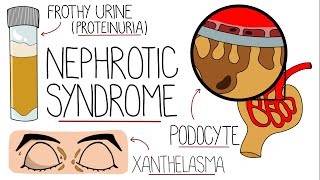 Nephrotic Syndrome Explained Clearly [upl. by Tekcirc]