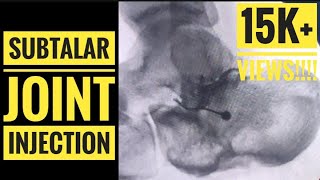 Fluoroscopic Subtalar Joint Injection [upl. by Ecahc]