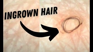 Satisfying Ingrown Hair Removal Compilation [upl. by Besse]