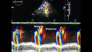 Eccentric aortic insufficiency echo to drahmadmirdamadisiicyHK3BApJFDys7 [upl. by Rabaj]