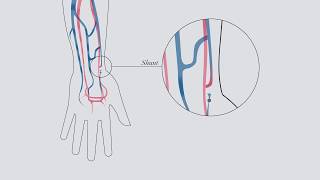 Understanding hemodialysis [upl. by Atsirt459]