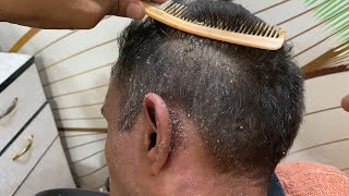 Omg 😱 old dandruff flakes scratching Indian video 🥵dandruff removal satisfying 💯psoriasis scratching [upl. by Airotnahs]