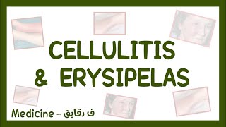 Cellulitis amp Erysipelas  clinical picture diagnosis amp treatment شرح عربي [upl. by Atirehc]