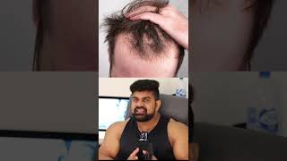 Does Creatine cause hair loss [upl. by Taveda]