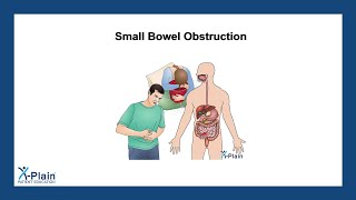 Small Bowel Obstruction [upl. by Little]