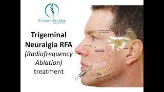 Trigeminal Neuralgia RFA Radiofrequency Ablation treatment [upl. by Mehs]