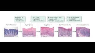 Progression of Squamous cell Carcinoma [upl. by Tol]