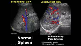 Spleen Ultrasound Normal Vs Abnormal Image Appearances Comparison  Splenic Pathologies On USG [upl. by Loree]