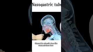 Nasogastric tube kaise dalte hai aaj esa video me channel pramoteyoutubembbs viralvideodoctor [upl. by Kronfeld]