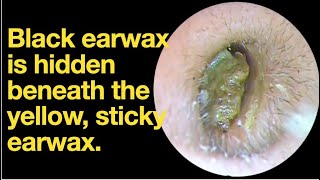 Black earwax is hidden beneath the yellow sticky earwaxear wax removal  ear cleaning  ASMR [upl. by Curr]