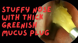 Stuffy Nose With Thick GREENISH Mucus Plug [upl. by Row]