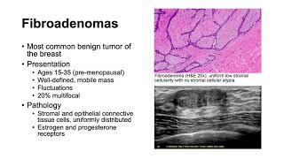 Fibroadenomas and Phyllodes Tumors [upl. by Ilowell988]