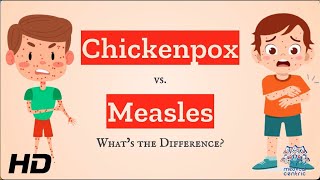 Chickenpox vs Measles Which is Which [upl. by Isidor]