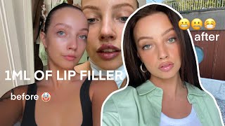 getting lip fillers for the first time  healing process start to finish [upl. by Tristram648]