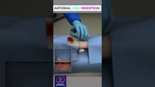 Arterial line insertion shorts [upl. by Marvella]