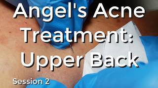 Angels Acne treatment Upper Back  Session II [upl. by Anileuqcaj509]