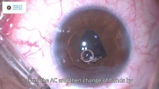 Subluxated Traumatic Mature Cataract  Iris Claw Lens  MEHRC  Dr Ashish K Jain [upl. by Lorain249]