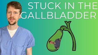 Gallbladder  Bile Duct Disease explained by a GI doc [upl. by Corella]