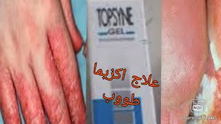 الطريقة الصحيحة لعلاج الالتهابات الجلدية والاكزيما والصدفية ومشاكل البشرة بالاخص باستعمال topsyne [upl. by Knorring964]