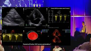 Estenosis Aortica Asintomatica Cuando pienso en Intervenir [upl. by Adnol]