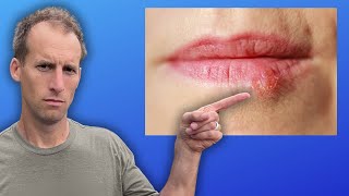 Natural Remedies for Cold Sores [upl. by Aggi]