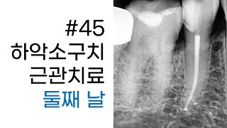 45  Mandibular Premolar Root Canal Treatment with Microscope 22 [upl. by Dracir]