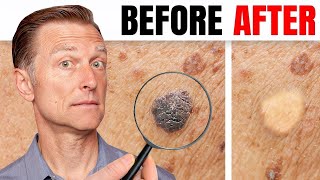 Top 5 Simple Tips for Tinea Versicolor [upl. by Ahsilad]