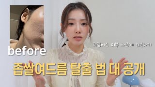 SUB ‘피부 뒤집어진 나의 과거…좁쌀여드름 극복 법 대 공개’  좁쌀 여드름 없애는 비밀 습관🤫  트러블 안녕 꿀템들 [upl. by Fanchie]