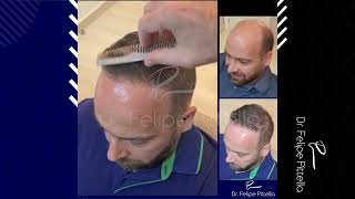 Dr Pittella • Norwood 7 Large head Poor donor Thin Hair [upl. by Mairim]