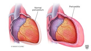 Mayo Clinic Minute What is pericarditis [upl. by Adnoyek529]